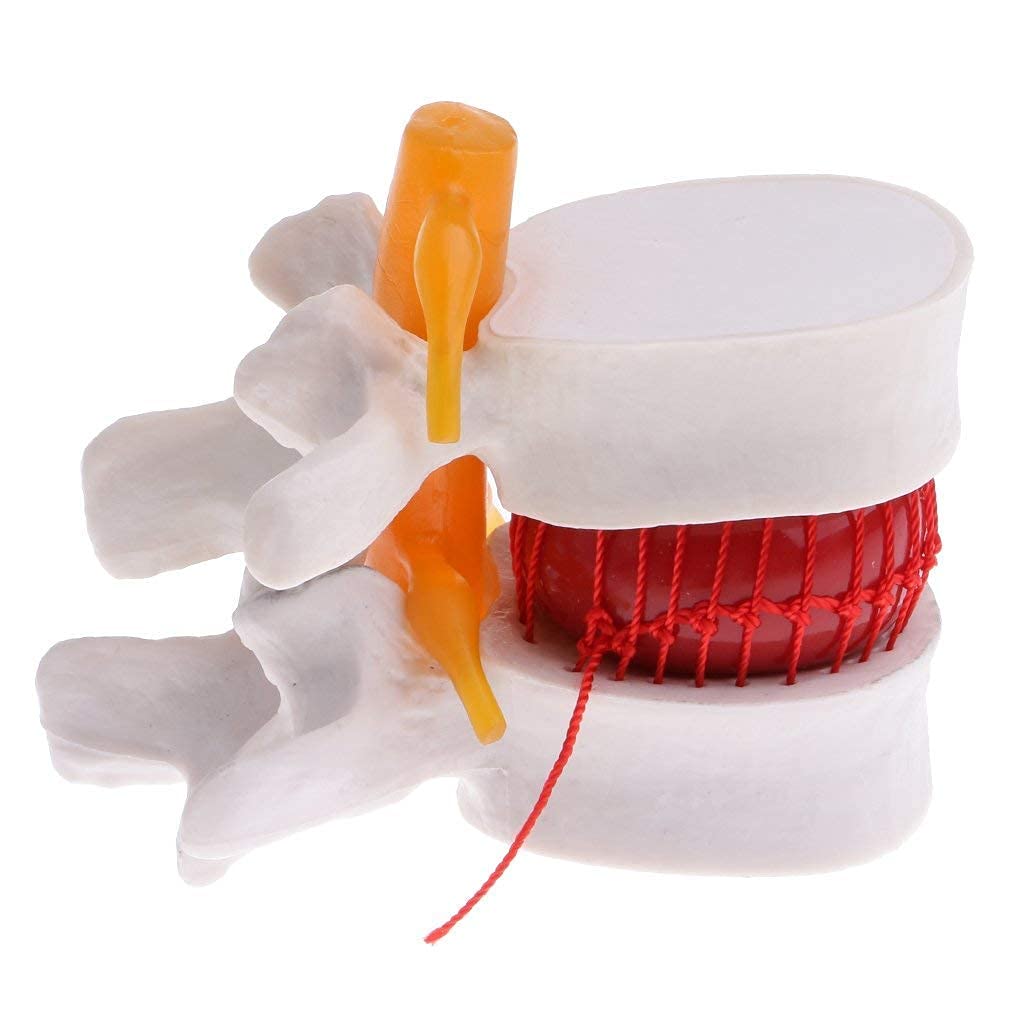 Modelo hernia de disco lumbar