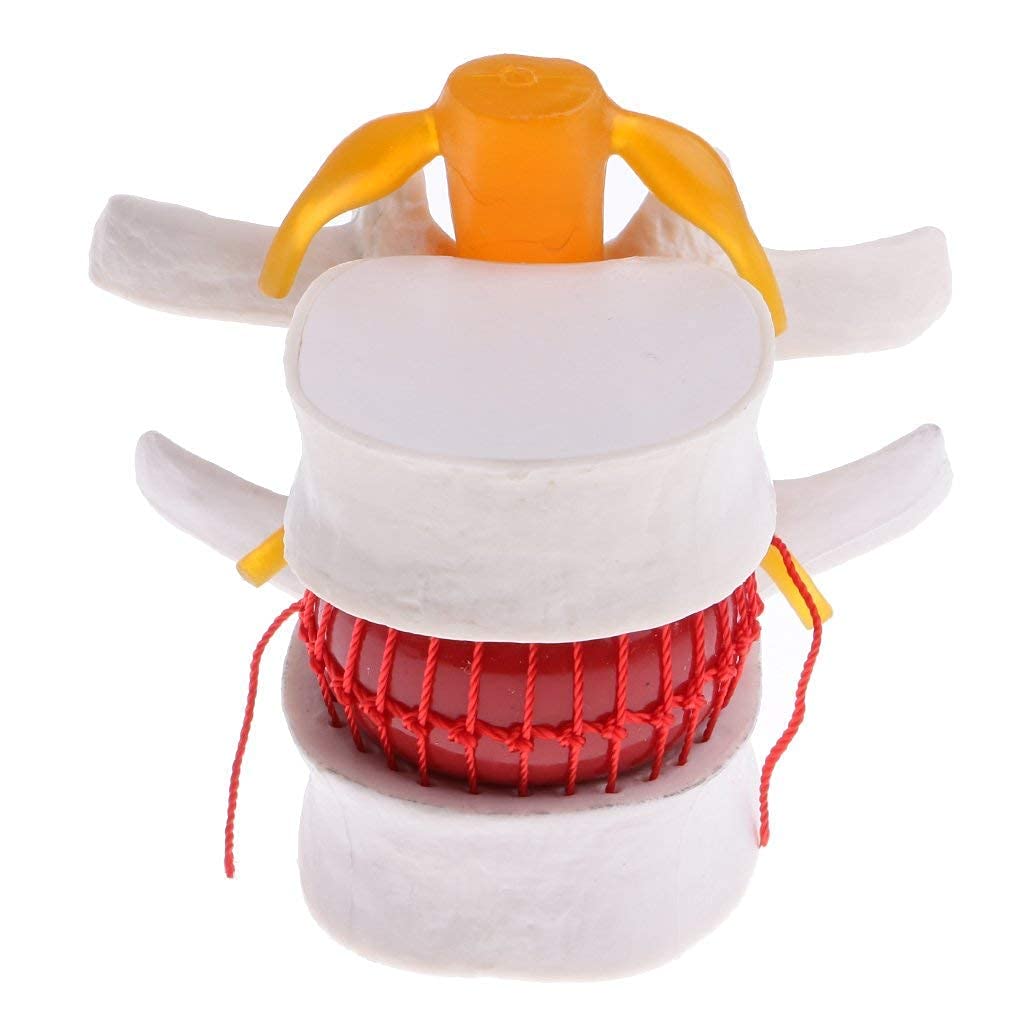 Modelo hernia de disco lumbar