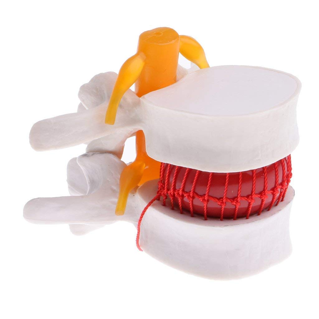 Modelo hernia de disco lumbar
