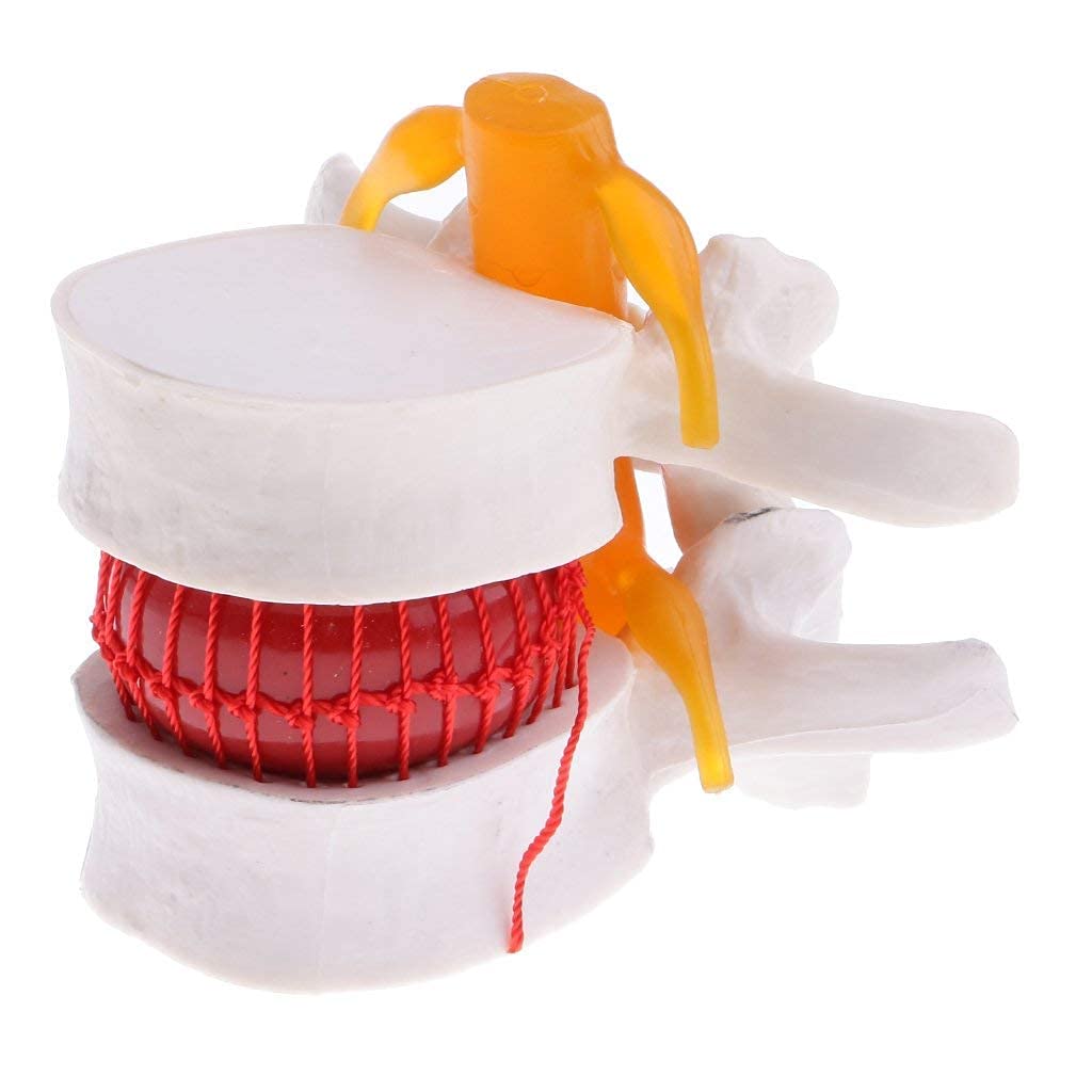 Modelo hernia de disco lumbar