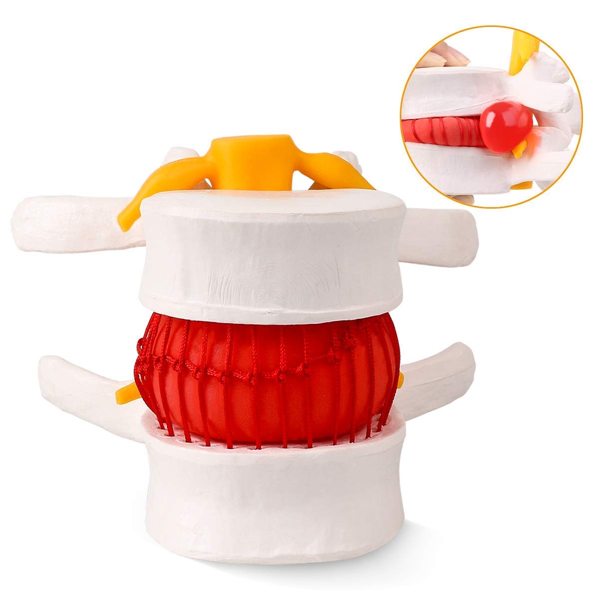 Modelo hernia de disco lumbar