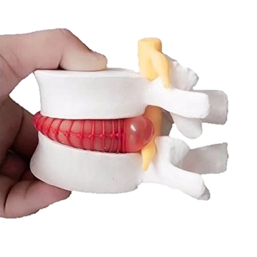Modelo hernia de disco lumbar