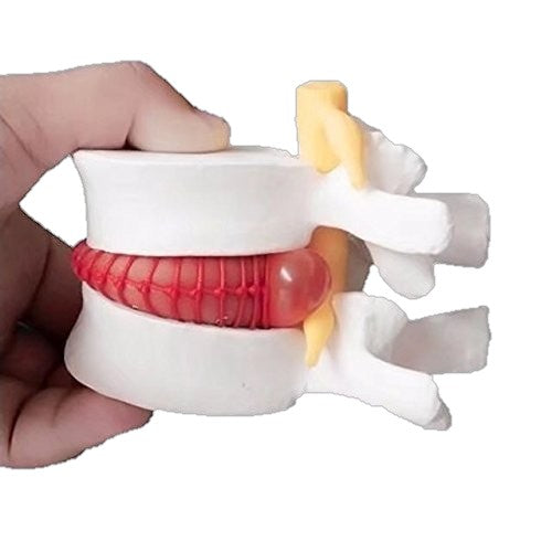 Modelo Hernia de Disco Lumbar