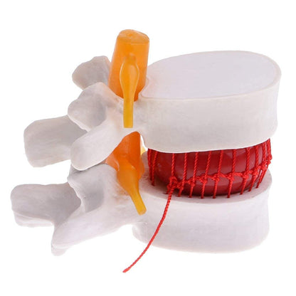 Modelo Hernia de Disco Lumbar