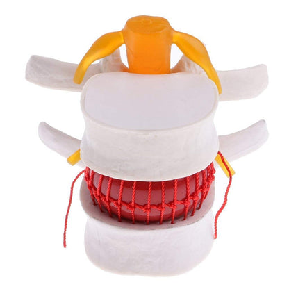 Modelo Hernia de Disco Lumbar